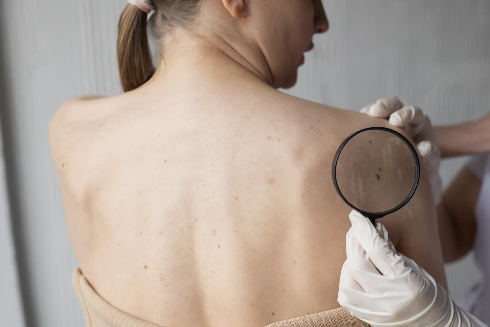 Pintas ou sinais na pele | Dermatologista Dra. Patrícia Cozzi